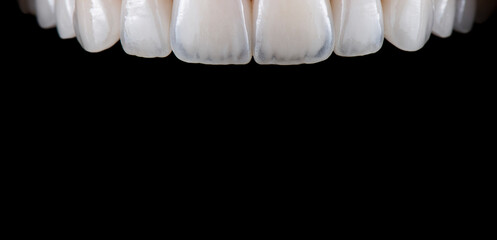 ceramic crowns and veneers b3 color