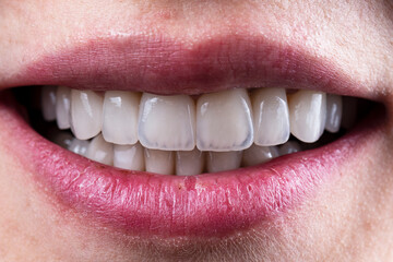Fototapeta premium ceramic crowns and veneers b3 color