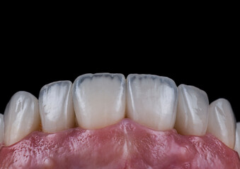 ceramic crowns and veneers b3 color