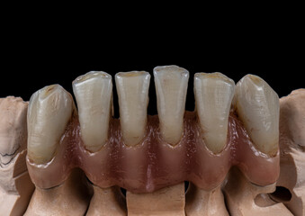 super natural metal ceramic bridge on implants