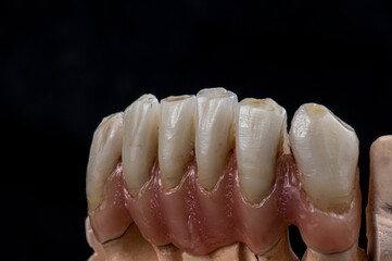 Fototapeta na wymiar super natural metal ceramic bridge on implants