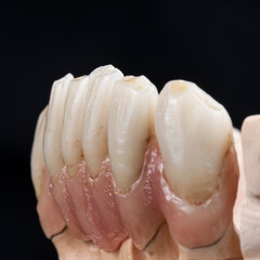 super natural metal ceramic bridge on implants
