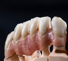 super natural metal ceramic bridge on implants
