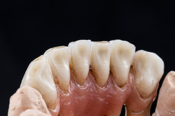 super natural metal ceramic bridge on implants