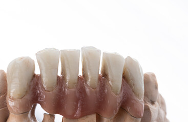 super natural metal ceramic bridge on implants