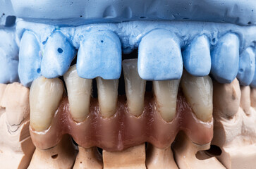 super natural metal ceramic bridge on implants