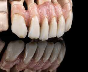 super natural metal ceramic bridge on implants