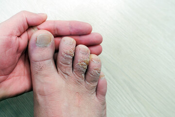 close-up foot skin diseases, callus formation on the fingers, calluses on the upper part of the toes,