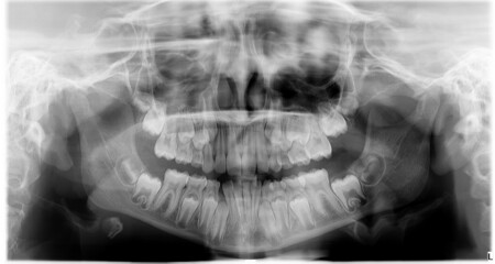 Dental x-ray scan of children teeth 