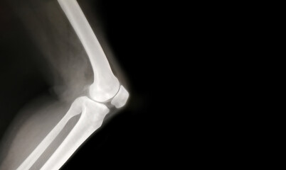 knee bone computer x-ray images