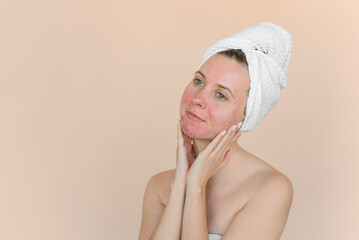 Young woman with problem skin touches her face and smiles. Girl with acne in white towel on a beige background.