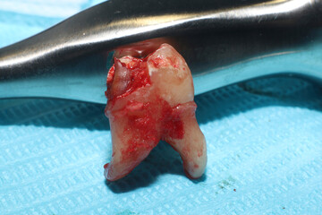 An extracted wisdom tooth on a sterile medical paper sheet