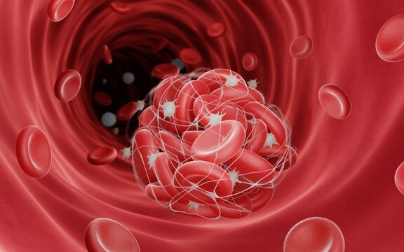 Blood clot illustration, Thrombosis is a dangerouse disease which can lead to a stroke or heart attack