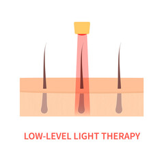 Laser hair growth stimulation. Red light therapy for hair restoration in androgenetic alopecia. Medical concept. Vector illustration.