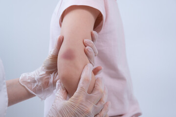 The doctor palpates the child's elbow. The traumatologist examines the site of injury. There is a bruise on the child's arm. Elbow injury