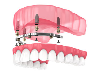 Bar retained removable overdenture installation supported by implants - obrazy, fototapety, plakaty
