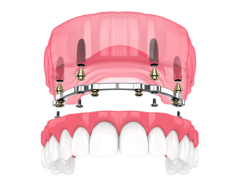 Bar retained removable overdenture installation supported by implants