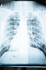 X-Ray Flim photo of young man and human healthy thorax.