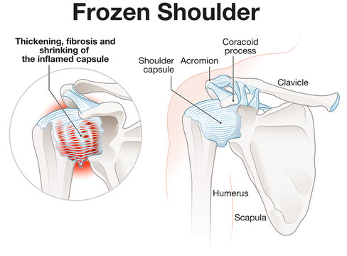 Frozen Shoulder Adhesive capsulitis Illustration. Labeled