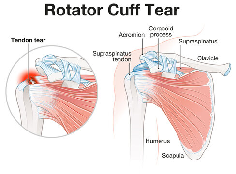 Rotator Cuff Tear Shoulder Illustration. Labeled