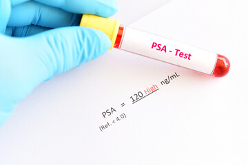 Abnormal high PSA test result with blood sample tube