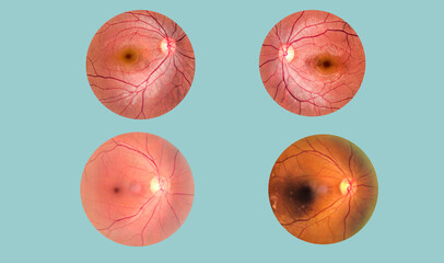 View inside human eye disorders - showing retina, optic nerve and macula.Retinal picture ,Medical...