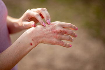 Close up dermatitis on skin, ill allergic rash eczema skin of patient , atopic dermatitis symptom...