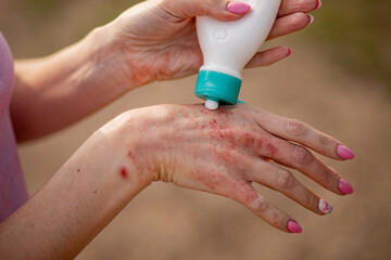 Eczema on the hands. The woman applying the ointment , creams in the treatment of eczema, psoriasis and other skin diseases. Skin problem concept
