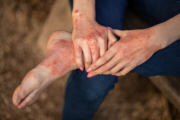 eczema dermatitis on hands and feet. red spots on the skin. dry skin