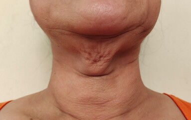 Portrait showing the flabbiness skin and wrinkled under the neck, problem skin of the woman, concept health care.