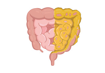 Half of the Intestines are healthy and the other half has accumulated fat. Concept Illustration about weight control and reducing fat.
