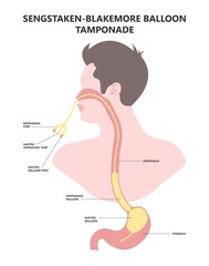 Weiss tear upper gastric ulcer portal liver veins clot blood stools scarring A B fatty bile duct alcohol exam band variceal fibrosis Oesophageal GI Nursing care swollen blocked varicose