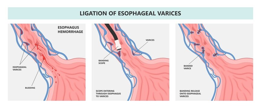 Weiss tear upper gastric ulcer portal liver veins clot blood stools scarring A B fatty bile duct alcohol exam band variceal fibrosis Oesophageal GI Nursing care swollen blocked varicose