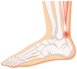 Achilles tendo rupture on white background