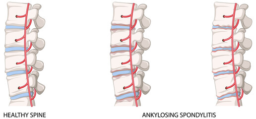 Infographic of healthy spine and ankylosing spondylitis