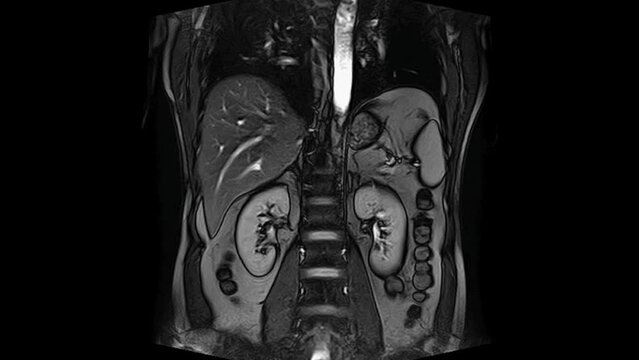 CT scan of the abdomen. Computed tomography of the gastrointestinal tract, liver and kidneys.