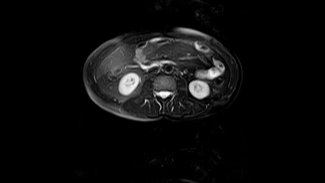 CT scan of the abdomen. Computed tomography of the gastrointestinal tract, liver and kidneys.