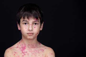Close-up of cute little children. Chickenpox virus or vesicular rash on a child's body