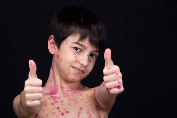 Chickenpox virus. Skin rash in a child.  Thumbs up. 8 year old boy