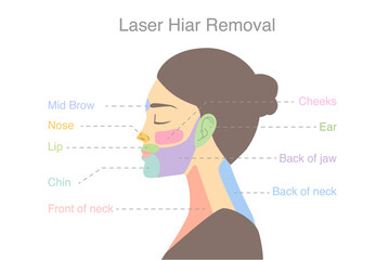 Highlight on woman's face area to do laser hair removal treatments. Illustration about diagram for a beauty treatment with laser.