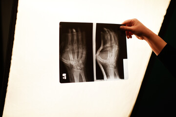 The nurse's hand is holding a x-ray photo of the arm. Arm fracture, medicine.