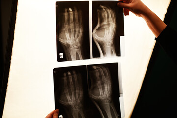 The nurse's hand is holding a x-ray photo of the arm. Arm fracture, medicine.