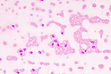 Red blood cells and white blood cells in blood smear, Wright-Giemsa stain, analyze by microscope,...