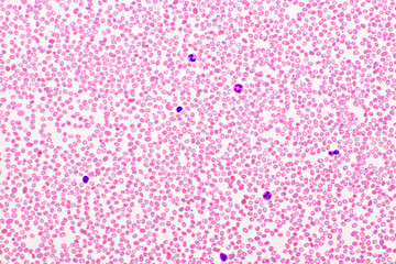 Red blood cells and white blood cells in blood smear, Wright-Giemsa stain, analyze by microscope,...