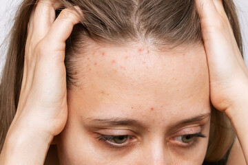 Cropped shot of a young woman's face with the problem of acne. Pimples on the forehead. Allergies,...