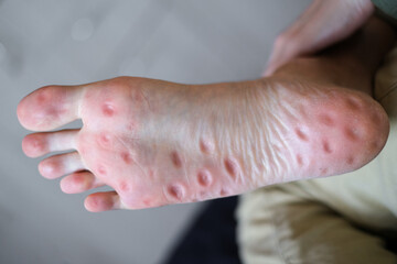 Fototapeta premium traces from a massager with spikes on the soles of the feet close-up. acupuncture