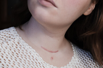 
Scar on the neck. surgical wounds, removal of tumor and thyroid cancer. Red scar on the larynx,...