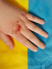 Wounded Hand on the Ukrainian flag