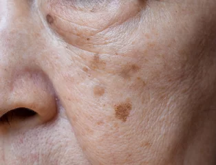 Fotobehang Small brown patches called age spots on face of Asian elder woman. They are also called liver spots, senile lentigo, or sun spots. © ZayNyi