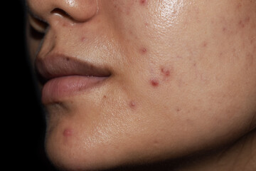 Acne, red spots and scars on face